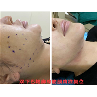 剥离微整下颚线