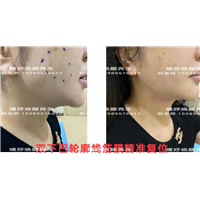 剥离微整下颚线
