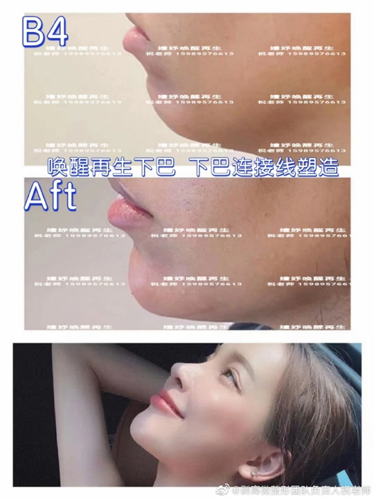 剥离祝老师