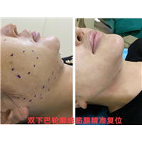 剥离微整下颚线