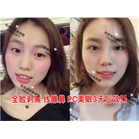 祝老师剥离微整
