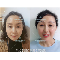 祝老师剥离微整