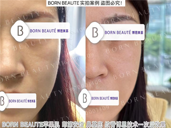 印第安纹剥离技术安全吗？做完之后会产生什么样的效果？