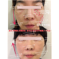 泪沟剥离8个月后 