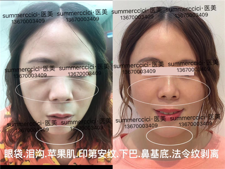 印第安纹剥离3次后效果 