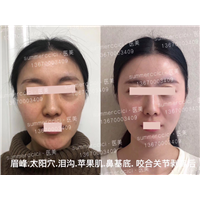 泪沟剥离2次后 