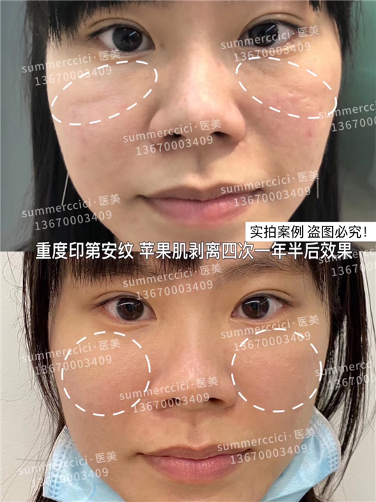 印第安纹剥离4次后效果 