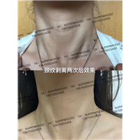 颈纹剥离2次后 