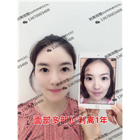 面部剥离术|依美国际剥离