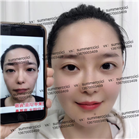 全脸剥离8个月后 