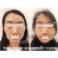 印第安纹剥离2次后效果 