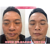 印第安纹剥离1次后效果 