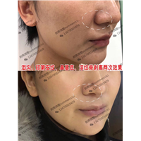 鼻基底剥离两次 