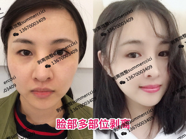 剥离微整价格|三维剥离