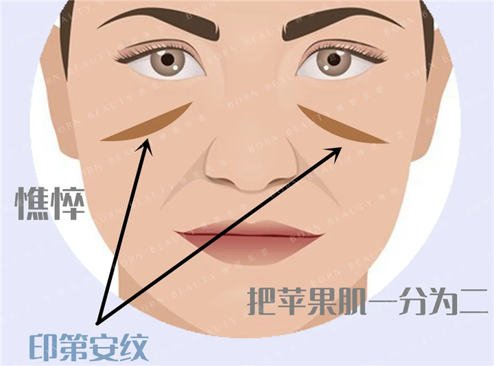 印第安纹打嗨体好还是玻尿酸好？彻底解决印第安纹这种方法才靠谱