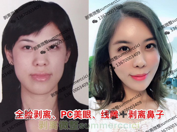 皮下剥离微雕|面部剥离术