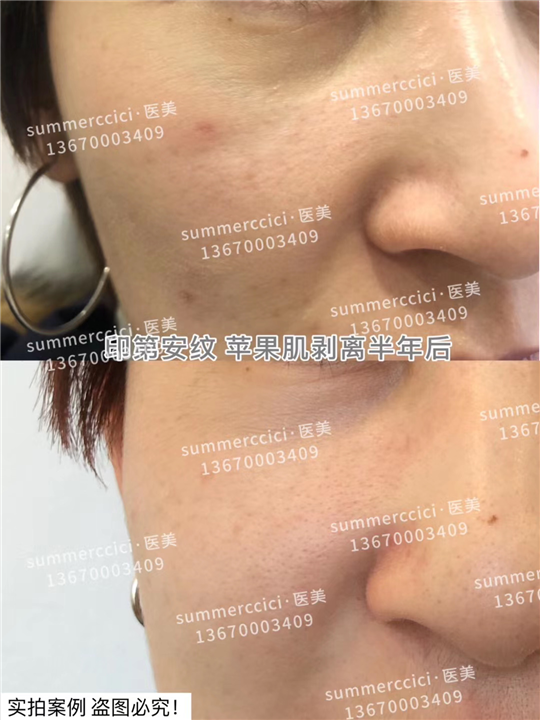 印第安纹剥离1次效果 