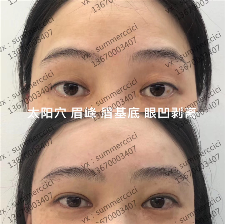 眼凹剥离后 