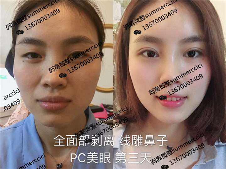 全脸剥离1年后 