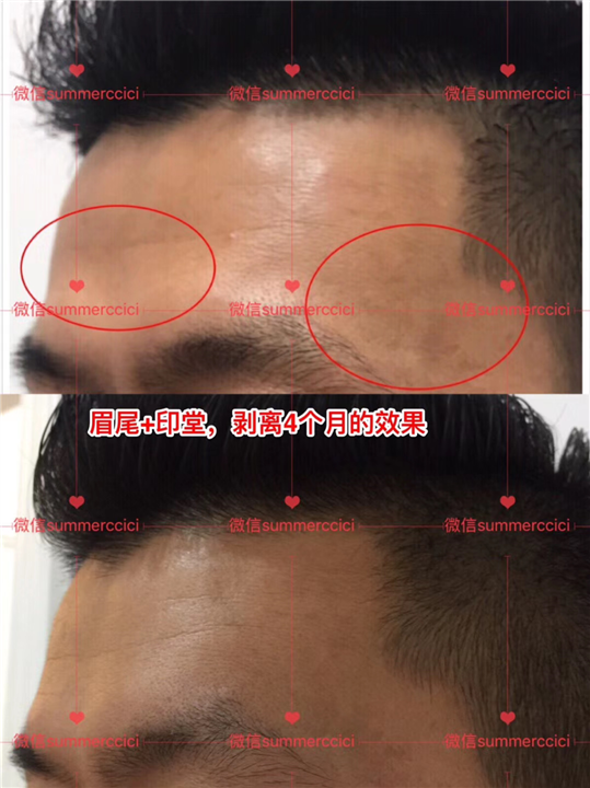 印堂剥离 