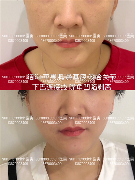 鼻基底剥离3次后 