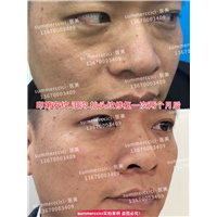 印第安纹剥离1次后效果 