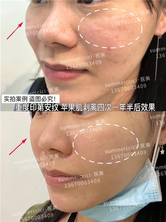 印第安纹剥离一年半效果 