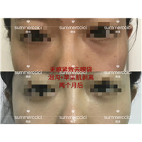 无痕祛眼袋2个月后 