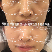 印第安纹剥离4个月后效果 