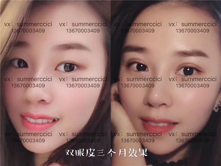 pc美眼3个月效果 