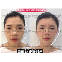 全脸剥离即刻效果 