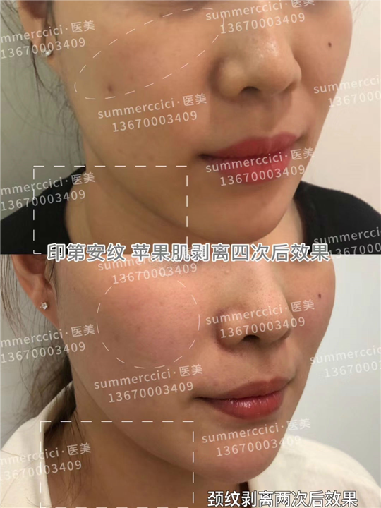 印第安纹剥离4次后效果 