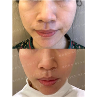 印第安纹会自己消退吗？如何正确对抗印第安纹的生长？