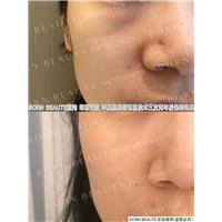 祛除印第安纹方法有哪些？会不会给面部皮肤造成伤害？