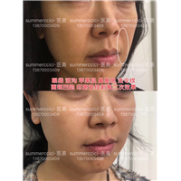 无痕祛眼袋加剥离泪沟4个月效果 