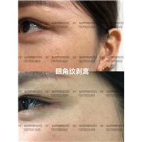 眼角纹剥离 