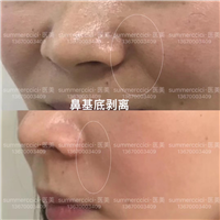 鼻基底剥离5个月效果 