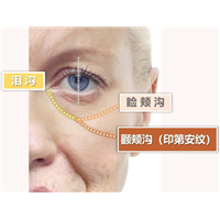 印第安纹对颜值的影响有多大？印第安纹该如何解决？