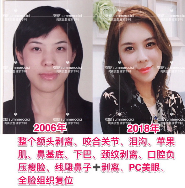 剥离微雕多少钱|剥离微整价格