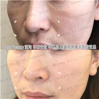 什么运动能够减轻印第安纹？印第安纹怎么去除效果好？