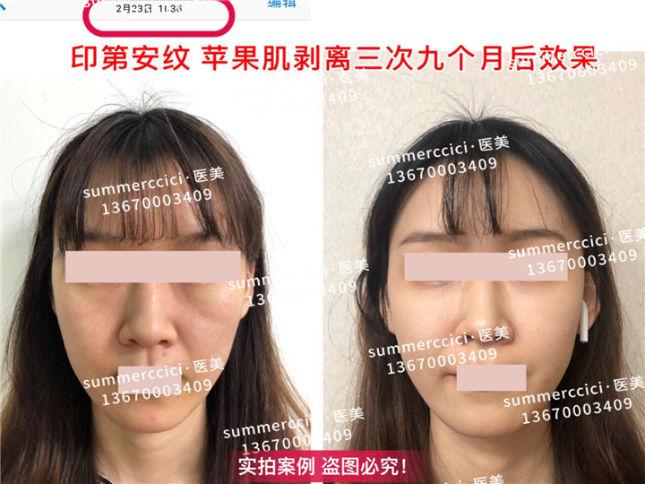 印第安纹剥离三次后 