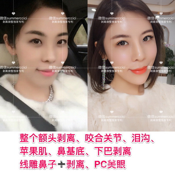 剥离微雕多少钱|剥离微整价格