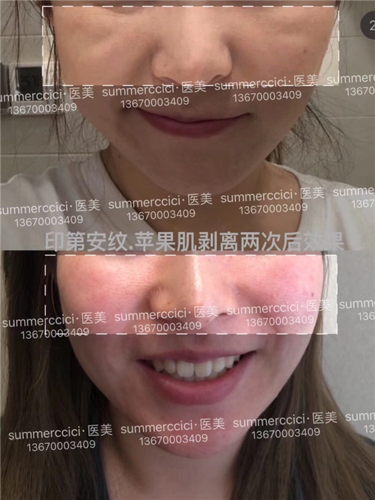 印第安纹剥离2次后 
