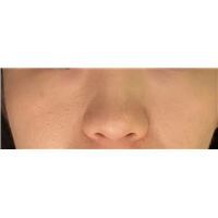 印第安纹等级自测，这种等级的印第安纹需要尽早解决
