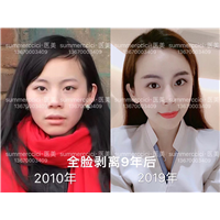 全脸剥离9年多 