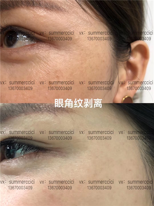 眼角纹剥离 