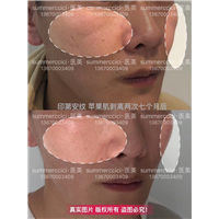 印第安纹剥离2次后 