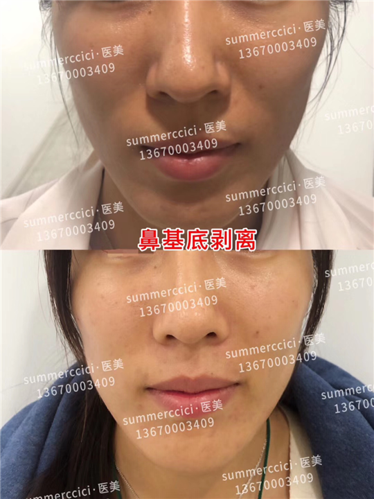 鼻基底剥离半年 