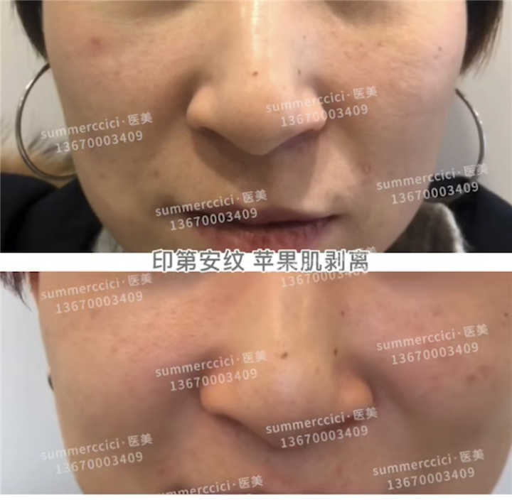 印第安纹苹果肌剥离1次效果 