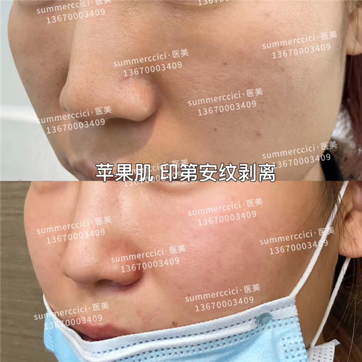 苹果肌印第安纹剥离 